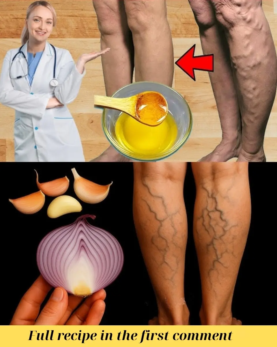 Garlic: Nature’s Secret to Soothing Varicose Veins Naturally
