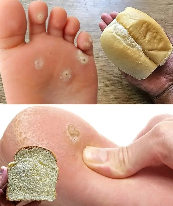 Remove Foot Calluses Naturally with This Simple Bread Remedy