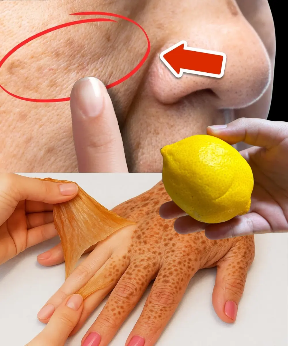How to Remove Age Spots Naturally with Lemon Juice