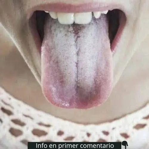 The Tongue as a Health Indicator: Meaning of a Whitish Color