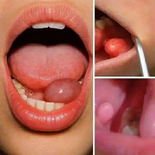 Hidden Dangers in Your Mouth: Early Signs of Oral Cancer
