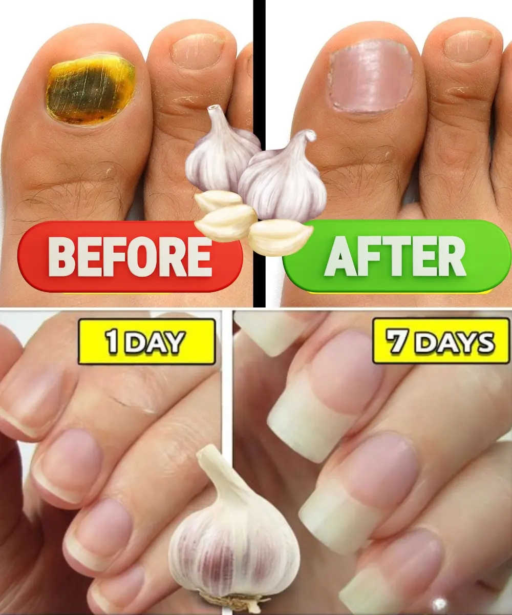 Garlic: The Natural Cure for Fungal Infections on Scalp, Hands, Nails & Feet