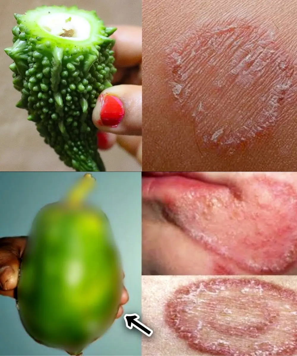 9 Powerful Home Remedies to Get Rid of Fungal Infection (Daad, Khaj, Khujli) Fast