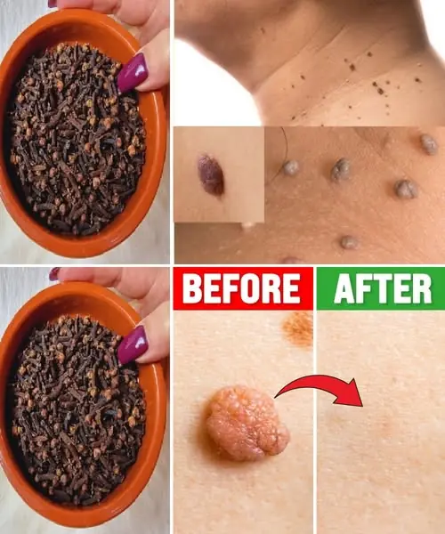 The Natural Clove Remedy for Skin Tags & Warts: Gentle, Effective, and Time-Tested