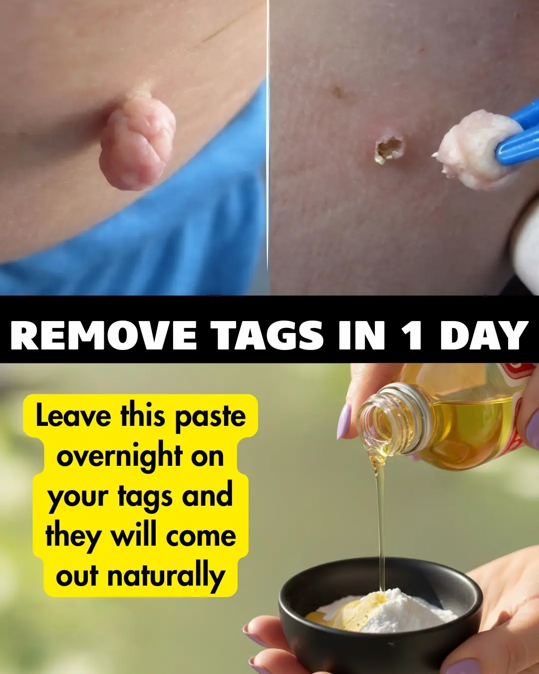 Best Natural Home Remedies To Safely Remove Skin Tags