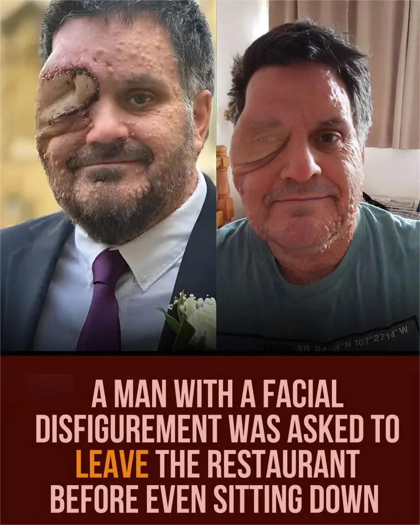 Man With Facial Disfigurement Asked to Leave Restaurant Before Sitting Down